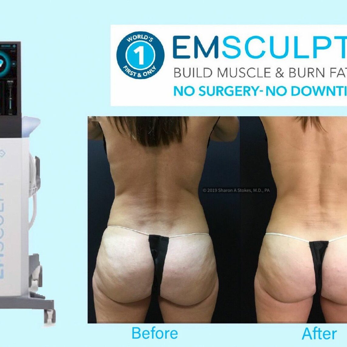 EMSCULPT OU IMPULSE