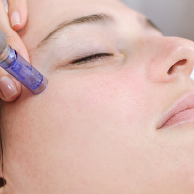 microneedling